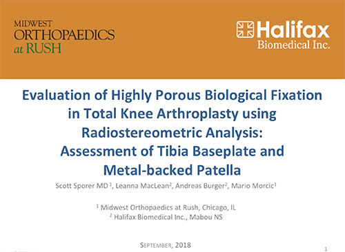 Dr. Sporer recently presented his research on the use of cementless knee implants at the annual closed meeting of the Knee Society.